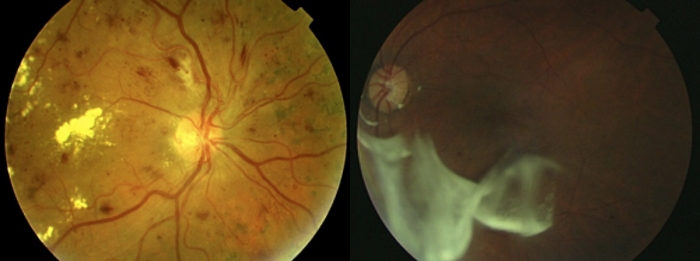Signos clínicos de retinopatía diabética (izquierda) y tratamiento con triamcinolona intravítrea (derecha)