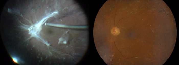 Ojo izquierdo de un paciente con tracción vitreomacular durante la cirugía (izquierda) y después de la intervención (derecha)