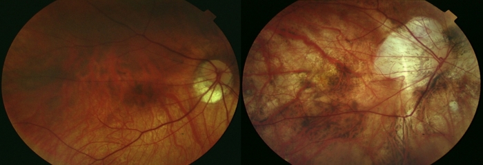 miopia magna en niños vederea unui ochi s-a deteriorat