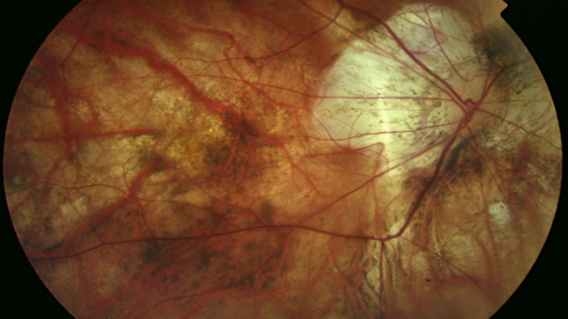 retina atigrada