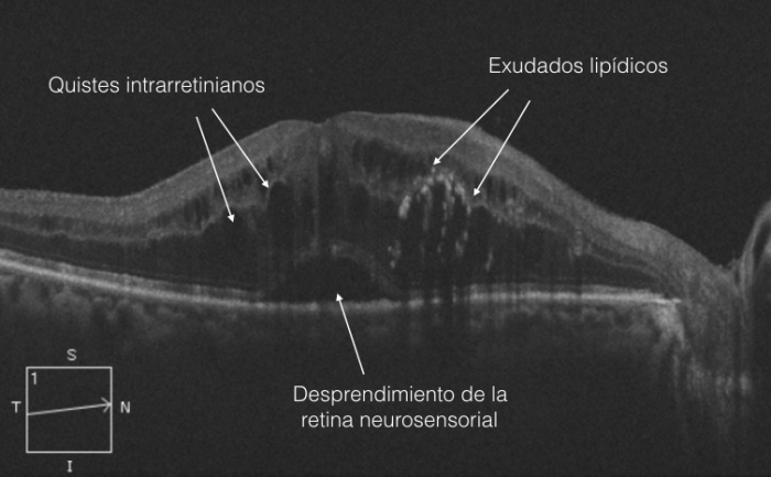 oct edema macular diabético