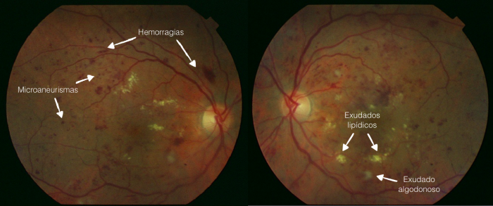 retinopatía diabética retinografías ao